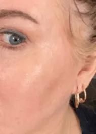 woman without acne after